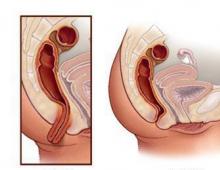 Выпадение прямой кишки (ректальный пролапс)